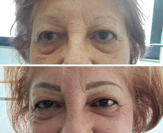 Galería Micropigmentación